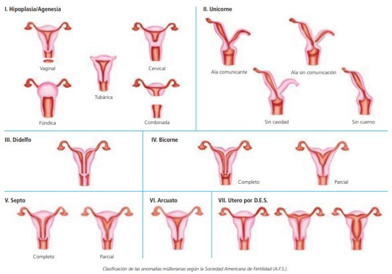 Malformaciones Uterinas Cong Nitas