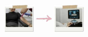 Secuencia visual en estilo polaroid que muestra el proceso tras una beta positiva en reproducción asistida: primero una analítica de sangre para medir la beta-hCG y, dos semanas después, una ecografía para confirmar el embarazo y detectar el saco y el latido embrionario.