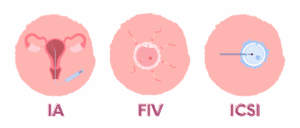 Ilustraciones de los tratamientos de reproducción asistida: Inseminación Artificial (IA), Fecundación in vitro (FIV) y microinyección espermática (ICSI)